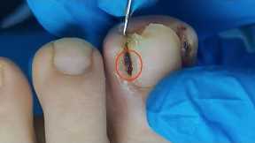 【Daily Pedicure Tutorial】Removing Deeply Embedded Ingrown Toenails on Both Sides of The Big Toe