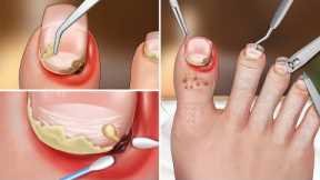 ASMR  Remove ingrown toenails, toenail clipping, toenail swelling and clean up pedicure