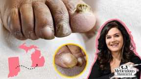 👣Thick Big Toenails from Indiana Find Help in Michigan👣