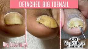 👣Big Toes Only - How To Pedicure Transformation for Men on Detached Toenails👣