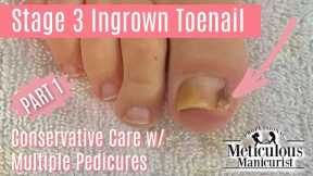 👣How to Pedicure Stage 3 Ingrown Big Toe with Granulation Tissue👣
