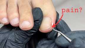 Pain there does not always mean ingrown toenails...! [Pro Nail Tech explains]