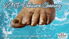 👣ASMR Pedicure Cleaning💆‍♀️Fix your Ingrown Pincer Toenails at Home👣