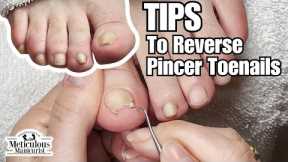 Pincer Toenail Transformation at Home #nails #satisfying