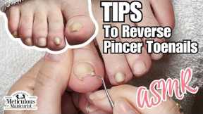 Pincer Toenail Transformation at Home ASMR Relaxing #nails #satisfying