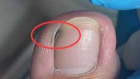 Nails are not cleaned properly and dirt is hidden