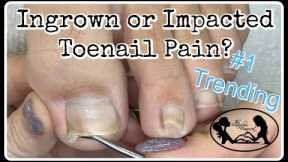 Impacted or Ingrown Toenail Pedicure Tutorial