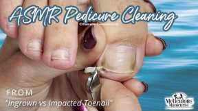 👣ASMR Pedicure Cleaning💆‍♀️Ingrown vs Impacted Toenail👣