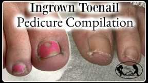 👣Satisfying Ingrown Toenail Pedicure Compilation👣