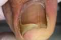 Amazing Curly Ingrown Toenails,