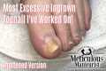 Most Extreme Ingrown Toenail Salon