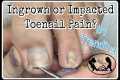 Impacted or Ingrown Toenail Pedicure