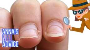 Extra nail layer growing on the nail? [Anna's Nail Advice]