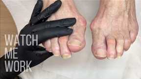 Cutting and maintaining THICK toenails.