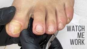 Pedicuring toes with nail surface damage and onycholisys due to micro trauma.