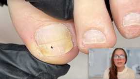 Cutting out a damaged toenail [Watch Me Work]