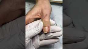 Broken nail repair and red French manicure