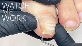 Fixing a very badly cracked toenail with gel  [Pedicure Part 1]