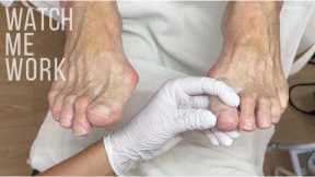 Gentle, professional care for mature feet, thickened toenails and dry skin vs. callus