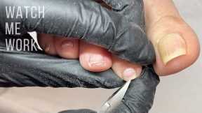 Pedicuring curved (involuted) toenails.