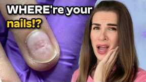 She ripped off her nail extensions...
